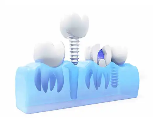 Implant Pre Operative Instructions