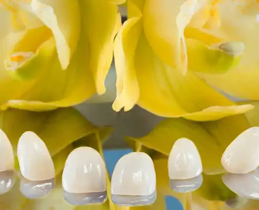 Veneers Post-Operative Instructions