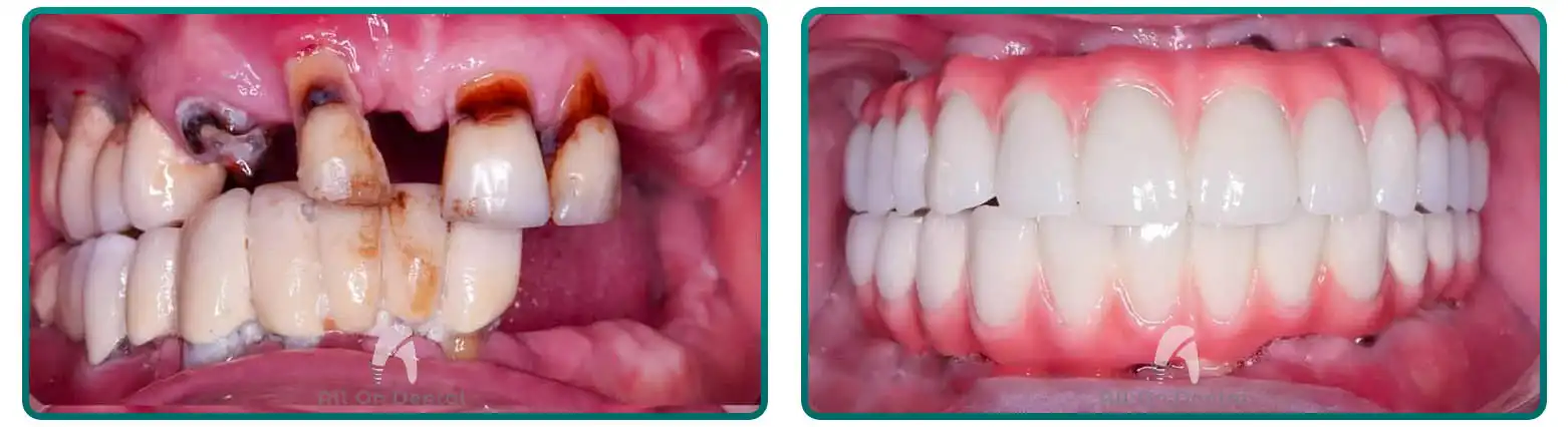 3-On-6 Before After Case 4