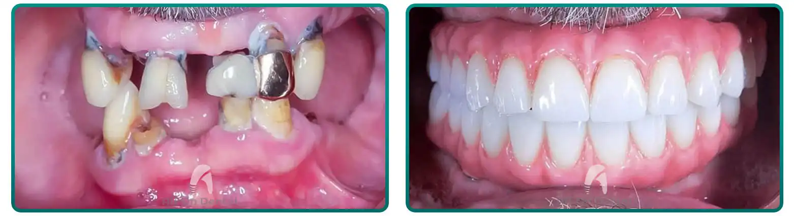 3-On-6 Before After Case 6