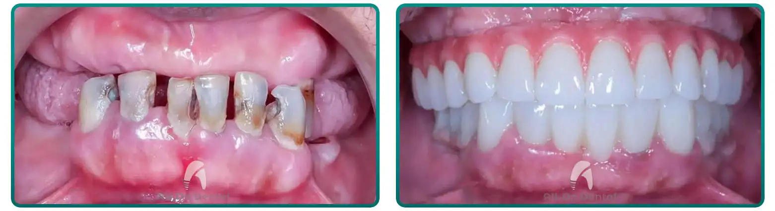 All-On-4 Before After Case 6