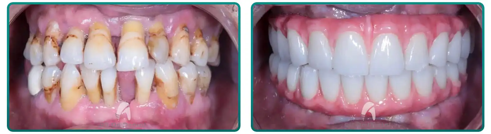 All-On-6 Upper Arch Makeover