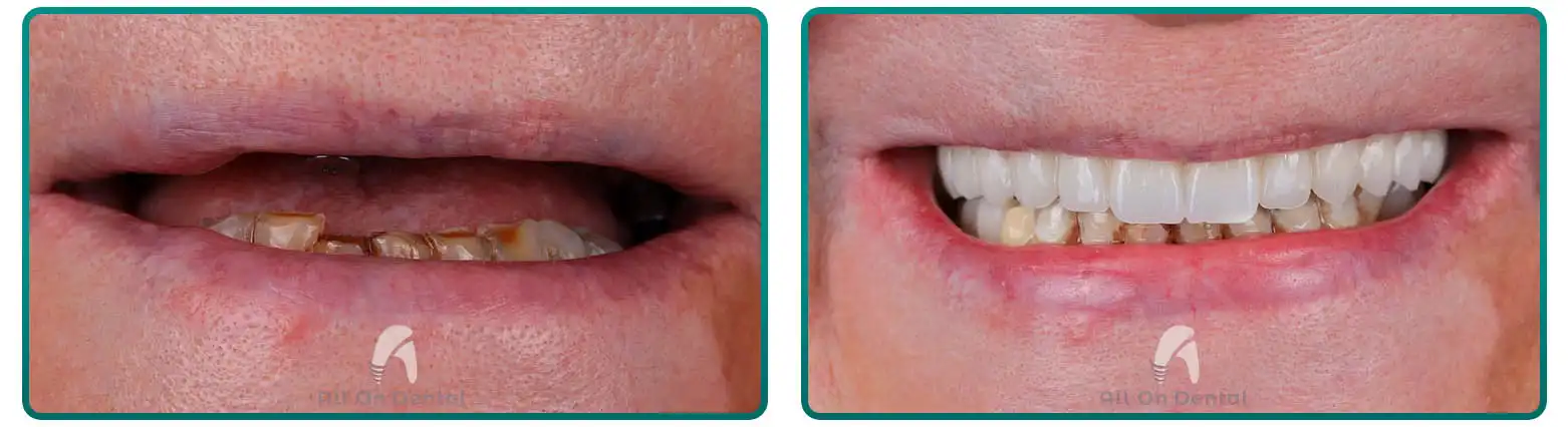 All-On-6 Before After Case 4