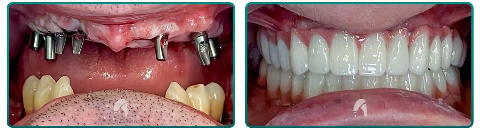 All-On-6 Bilateral Solution