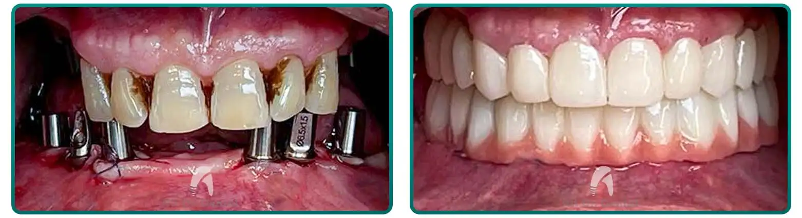All-On-6 Before After Case 6