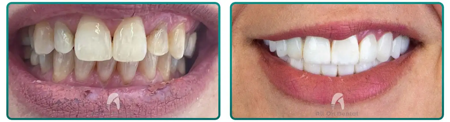 3-Unit Dental Bridge