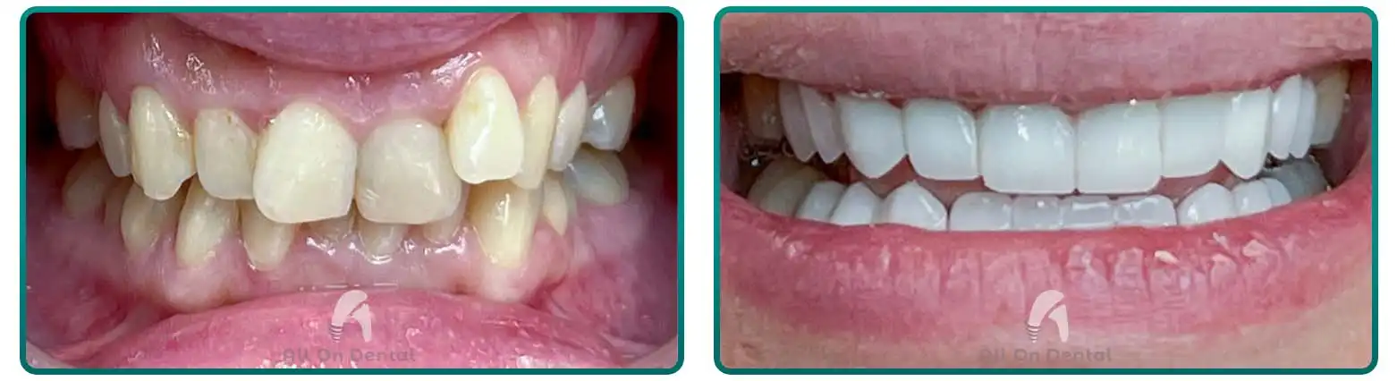 Dental Bridge Before After Case 10