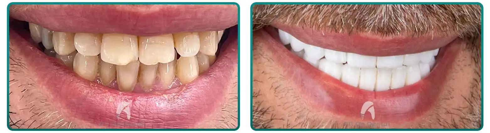 Dental Bridge Before After Case 2