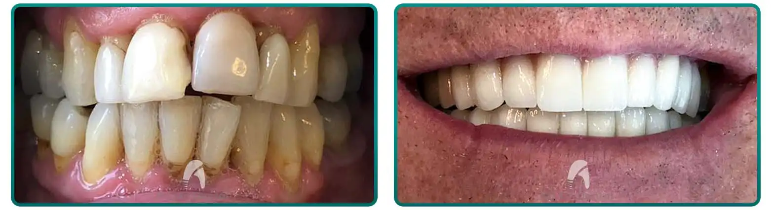 Multiple Unit Bridge