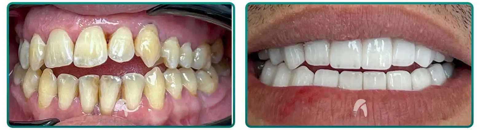 Porcelain Bridge Restoration