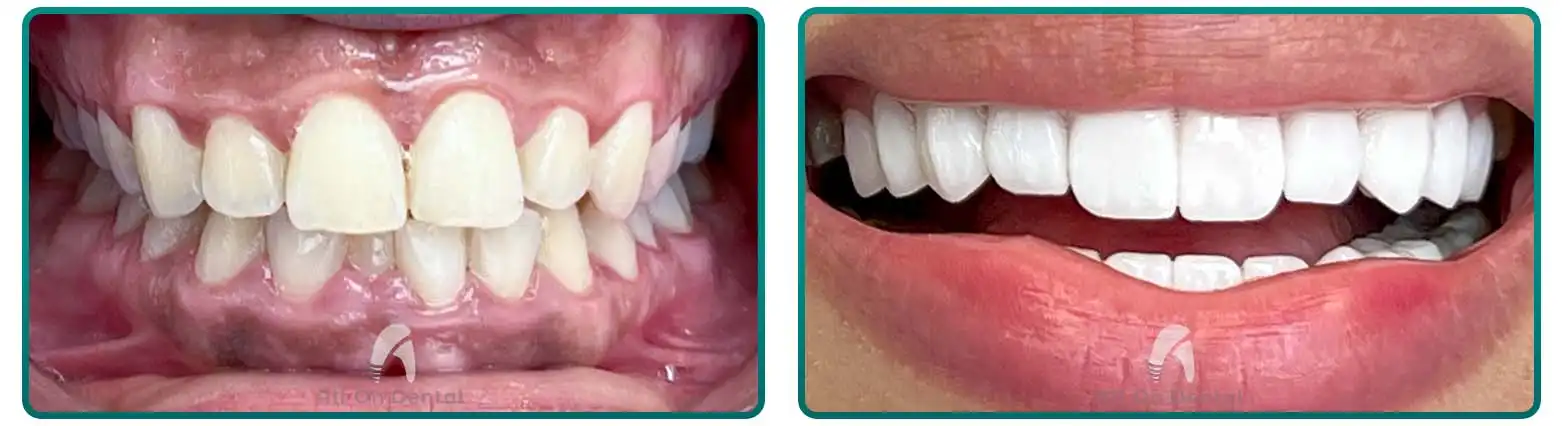 Dental Bridge Before After Case 6