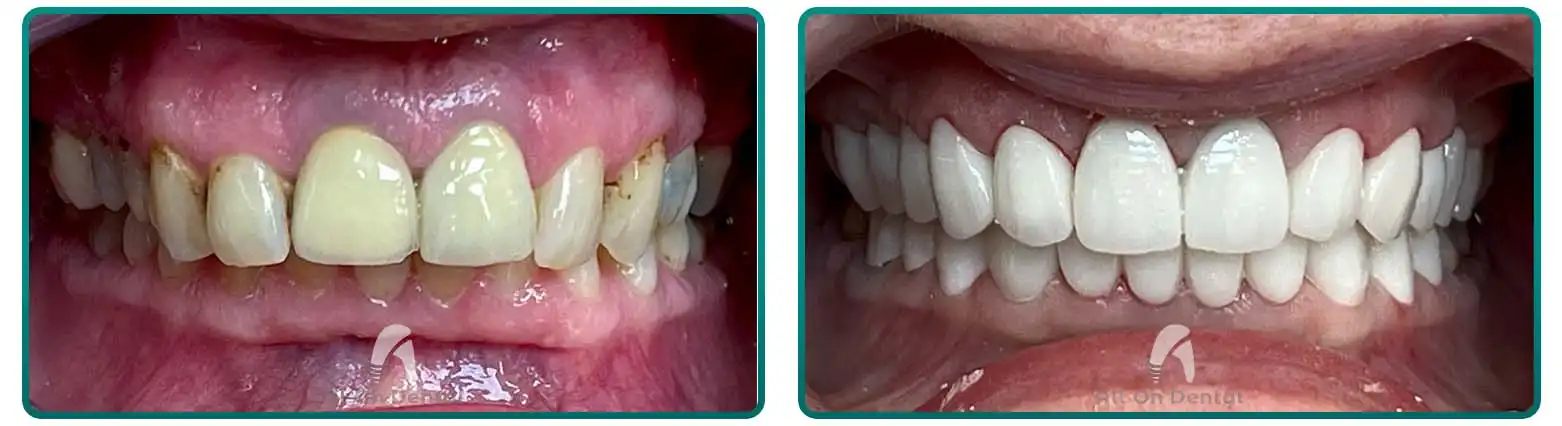 Front Teeth Bridge