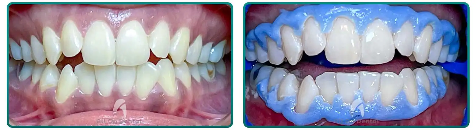 Teeth Whitening Before After Case 2
