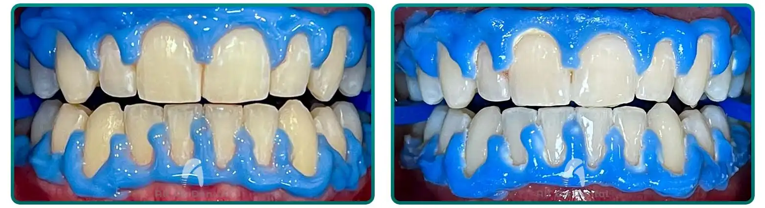 Zoom Whitening Treatment