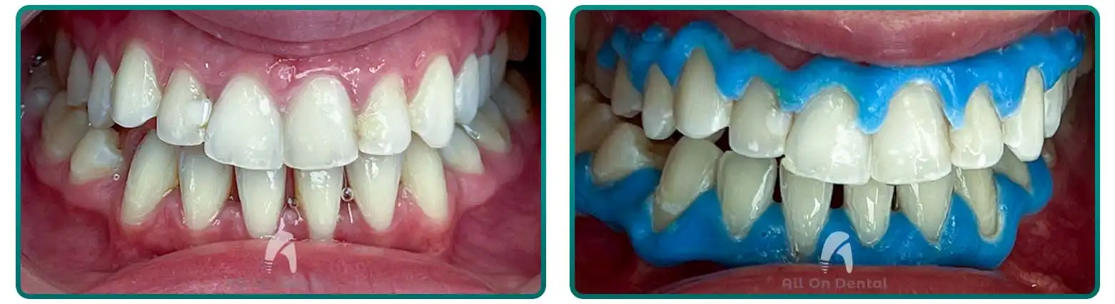 Teeth Whitening Before After Case 6