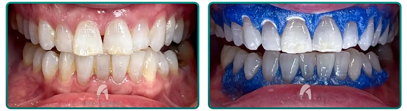 Hollywood White Smile