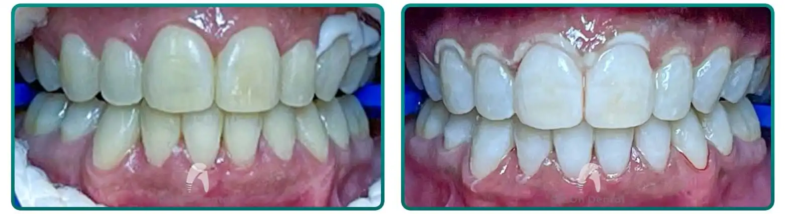 Teeth Whitening Before After Case 8