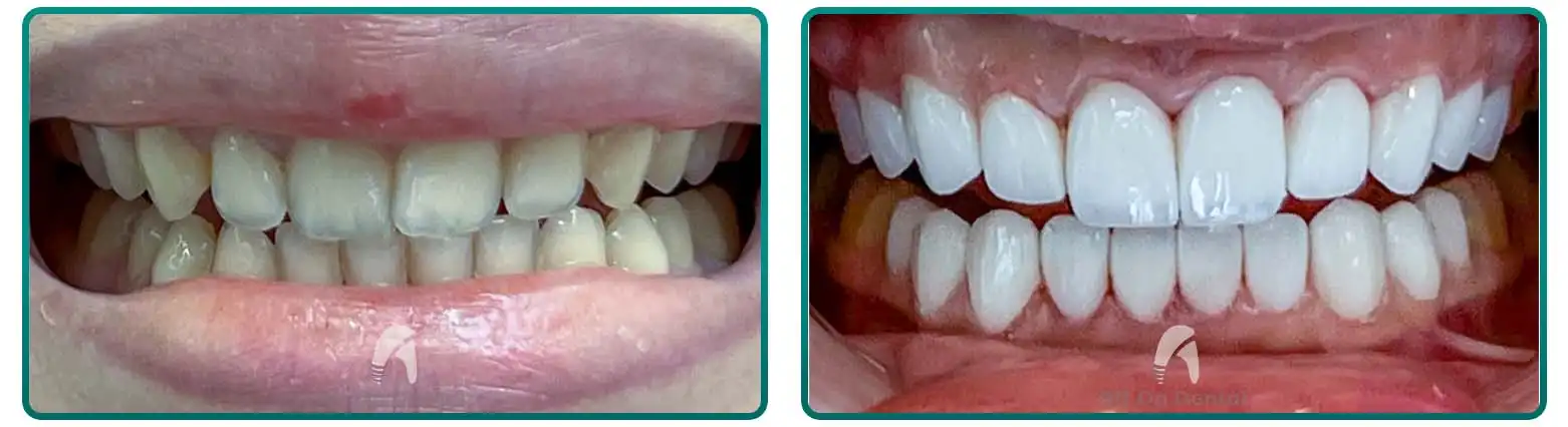 Veneers case 2