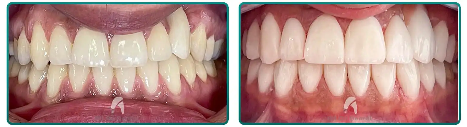 Veneers case 6